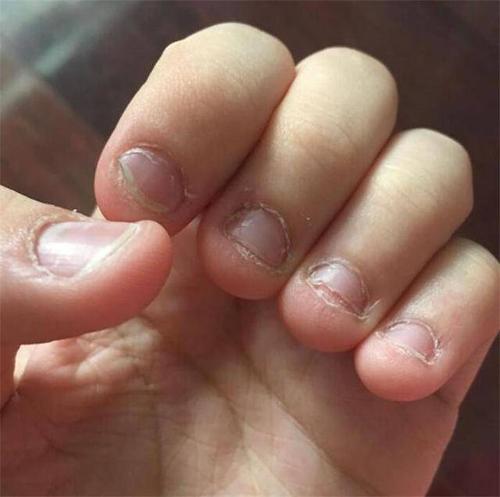 孩子总爱啃指甲是缺铁还是缺锌心理学家缺的其实是这一样