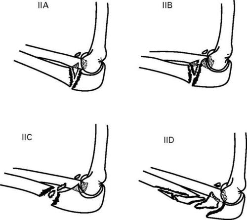 图7. monteggia 骨折 jupiter 分型