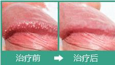 "dna技术"治疗男女尖锐湿疣前后对比图