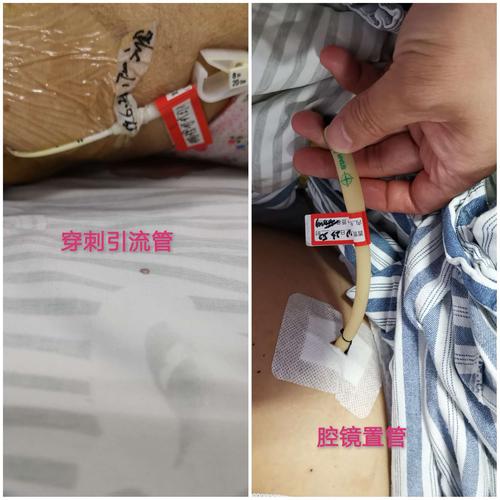 传说中急性胰腺炎腹腔积液!