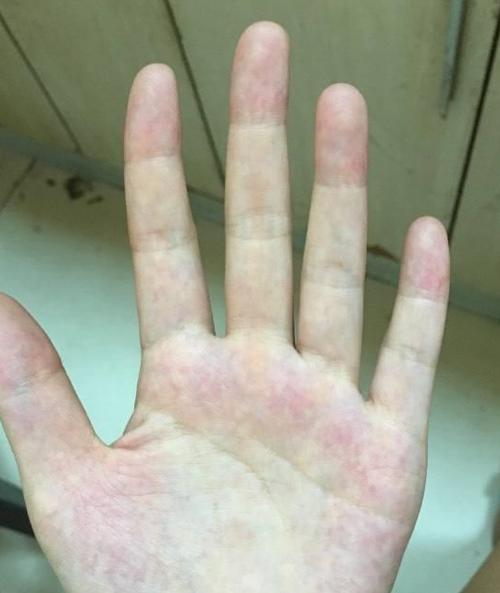 有肝掌肝病会很严重吗