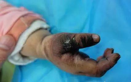 湛江一小孩玩耍时将钥匙插进了电动车充电口结果小孩的手指被电到发黑