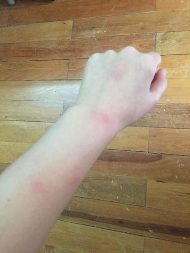 螨虫叮咬后的症状痒