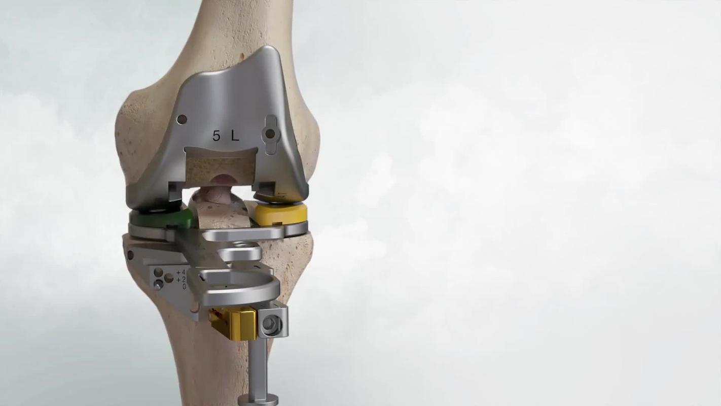 三维人体骨骼关节坏死人工全膝关节置换术