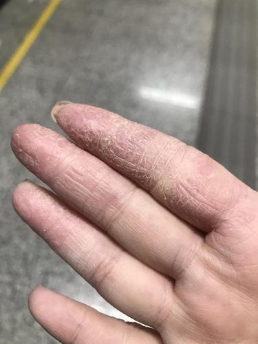 有没有人手上得过湿疹?饱受折磨好几年了
