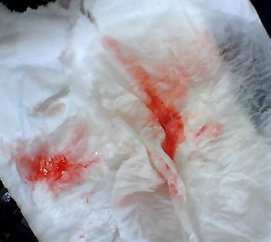 半个月前有血丝痰一查竟是肺癌在搞鬼