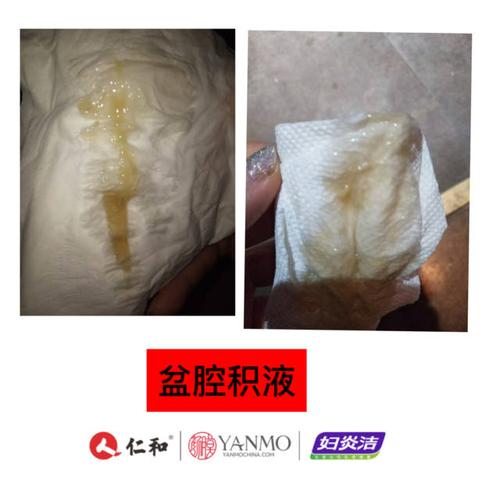 女性使用妇炎洁她秘密私护后,分泌排泄物对照图讲解