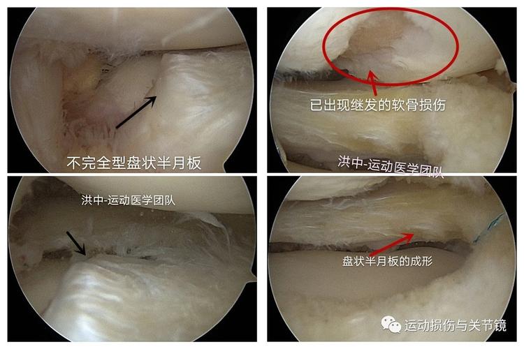 写美篇 病例一,不完全型盘状半月板成形术 盘状半月板手术中需要用到