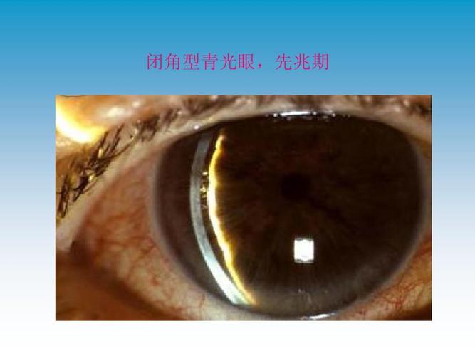 闭角型青光眼,先兆期
