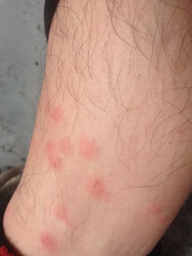 感觉应该是湿疹什么的.请问我这