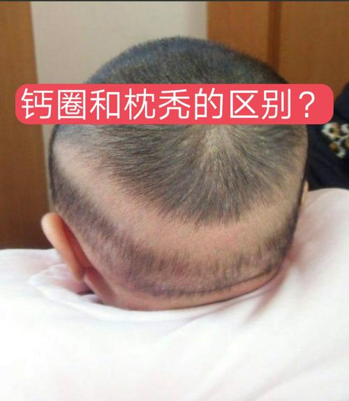 钙圈是枕秃的一种,是因为的