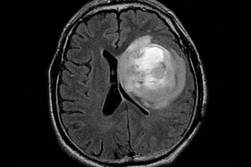 大妈疫情忍腹痛,pet-ct查出大端倪