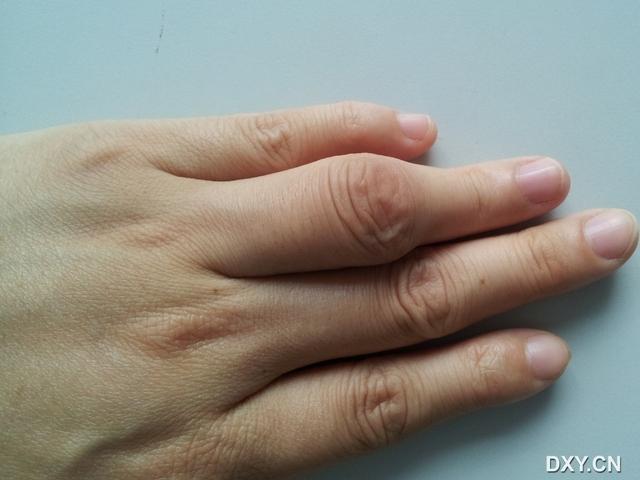 病例求助:左手近节指间关节肿胀4年