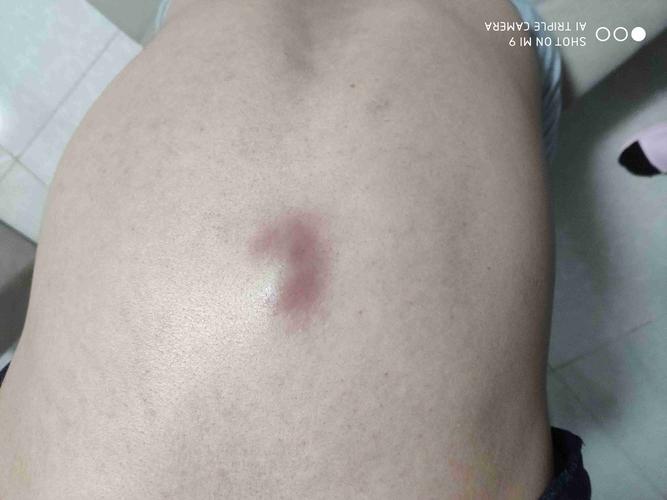 背上长了个疙瘩,有知道怎么治疗或者里面长的什么吗?