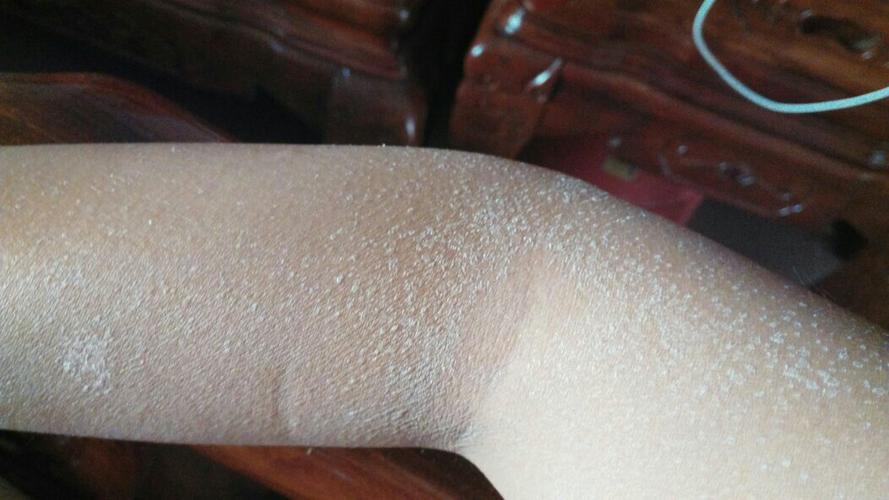 军训后的起皮与脱皮,弄水后还是会有,有人叫我去