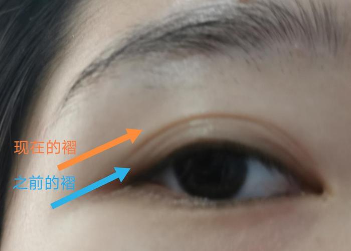 更新|一只眼睛外双,一只内双的姐妹有救了