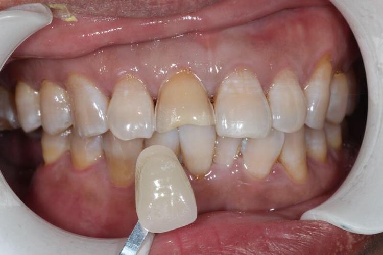 右上1牙周膜完整,根尖部有小低密度阴影 诊断:右上1牙体缺损,牙震荡伤