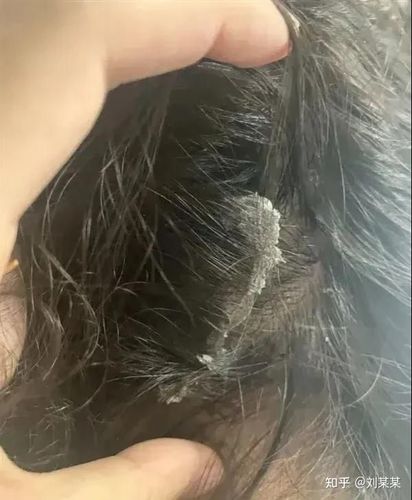 见过的最大头皮屑多大?
