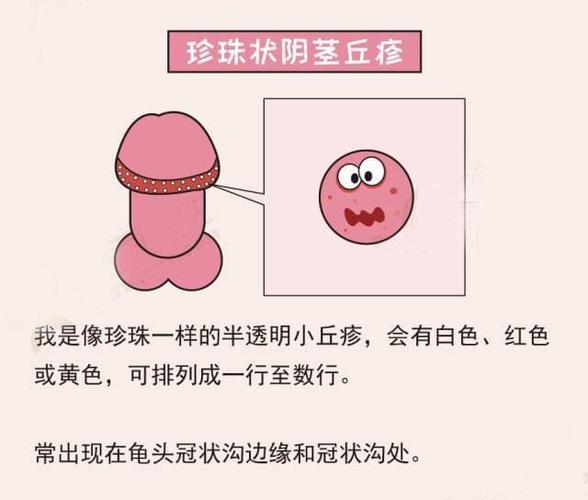 丁丁上长了小疙瘩!我是得性病了吗