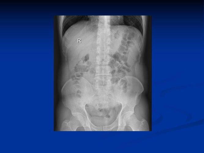 高清图片文字讲解肠梗阻的分类及影像学表现