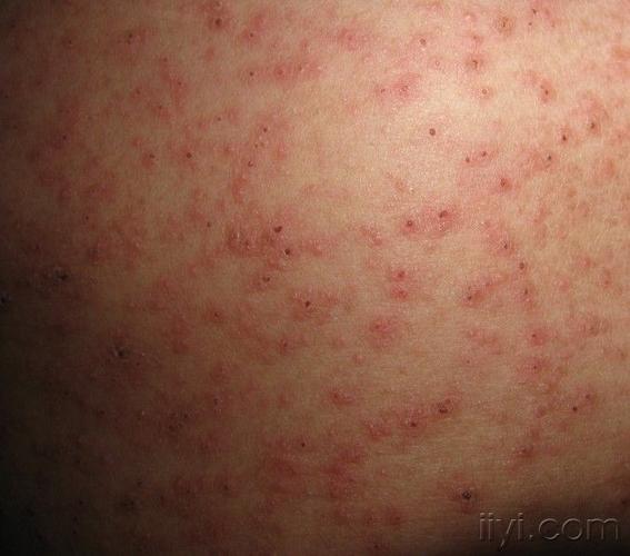 这是什么病?疥疮吗?