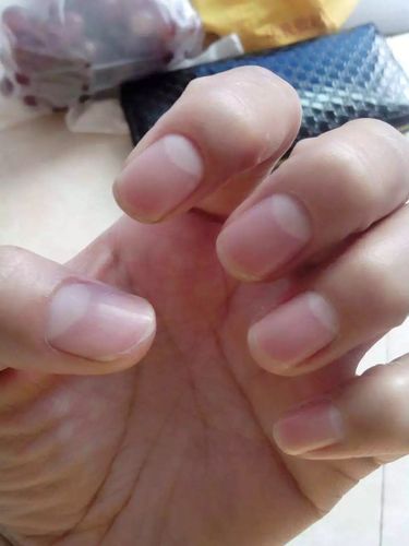 导致内分泌紊乱,而指甲生长速度会更慢,因此在手指上呈现出来的月牙