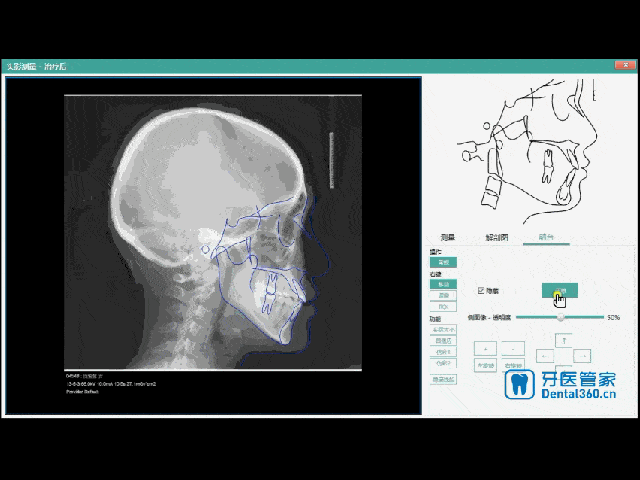 结合,3s帮你将描绘完成的解剖结构图与侧位片,侧面像完美融合,耳点等