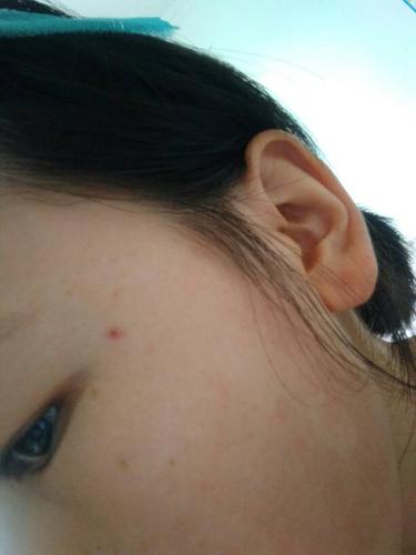 眼睛旁有个红点,很长一段时间了,是什么