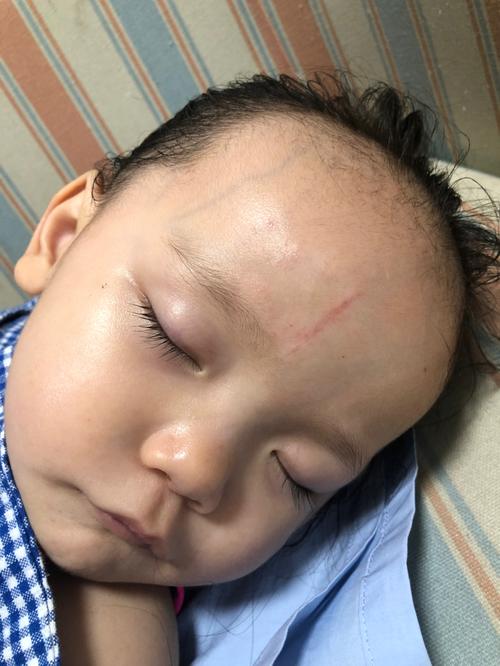 缝针后两个半月苹果原相机无p图疤痕状态_疤痕_相机_母婴_育儿经验