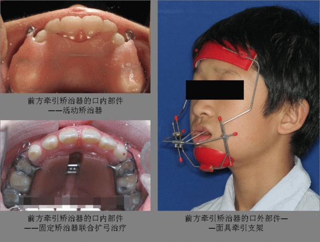 矫治器由口内部件和口外部件两部分组成,口内部件为活动或固定矫治器