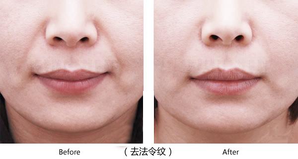 玻尿酸去法令纹后表情会不会僵硬