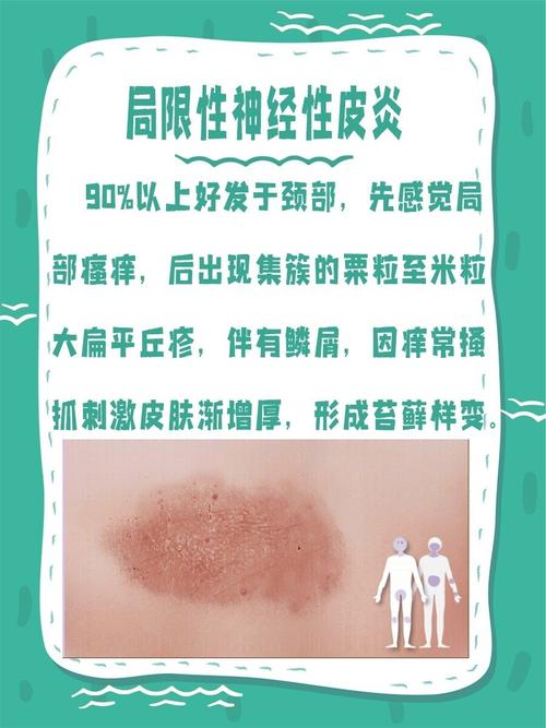 神经性皮炎一周和它说拜拜!