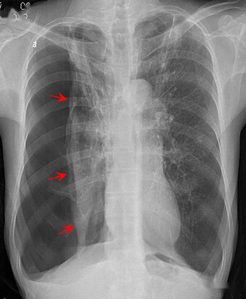 气胸时如何大体判断肺被压迫的程度?