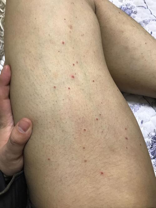 最近腿上出现很多这样的红点,不痛不痒