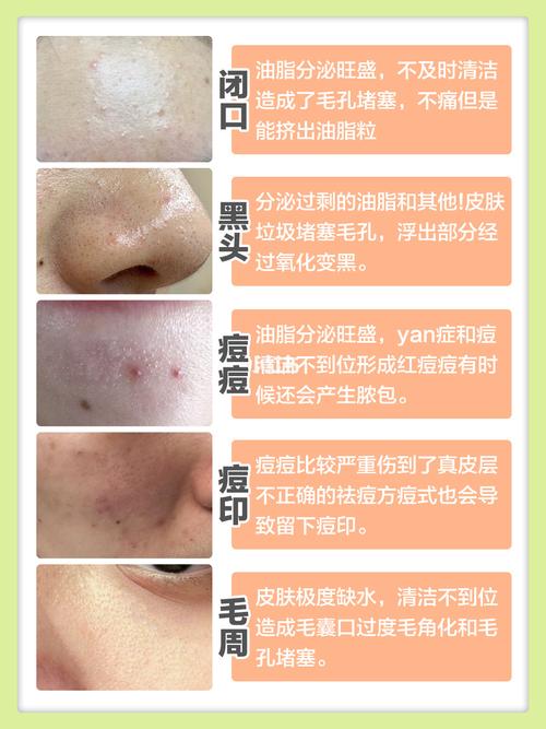 闭口和痘痘7515康康我是如何把它们弄干净的_痘痘