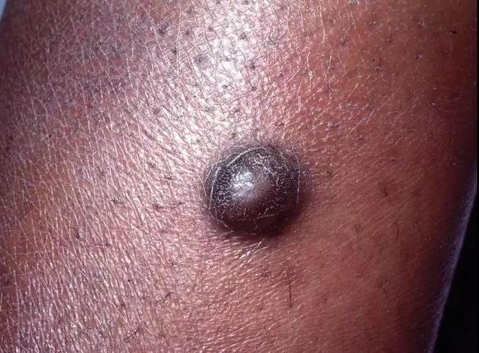 隆突性皮肤纤维肉瘤:是一种罕见的局部侵袭性梭形细胞肿瘤,好发于