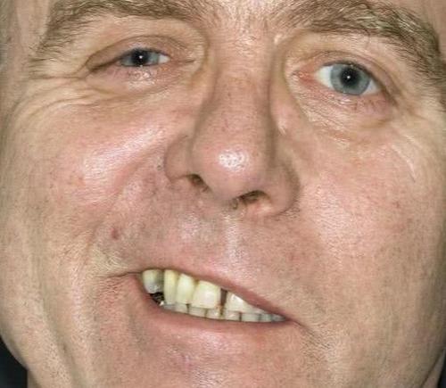 医生:口角歪斜难闭眼,这些原因致面瘫