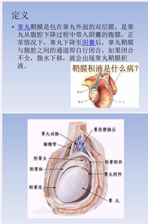 蛋蛋的忧伤阴囊疾病之睾丸鞘膜积液