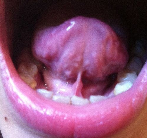 舌下很多肉粒,请各位帮我看看是不是尖锐湿疣.