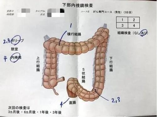 在日本做肠镜是怎样一种体验