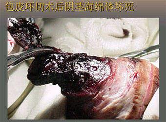 包皮过长及包茎有哪些危害?该如何治疗?