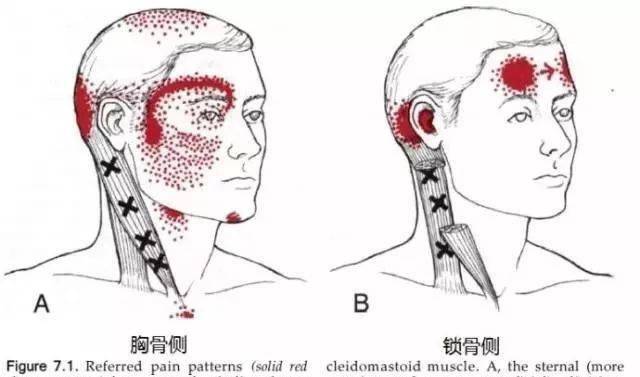 三,颞肌(temporalis)