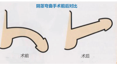 生殖整形 正文    在临床医学的诊疗记录中,其实男性朋友阴茎弯曲的
