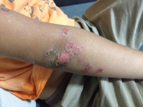 手上脸上皮肤溃烂,看医生说没明显特征,只叫擦绿药膏,但越来越严重了