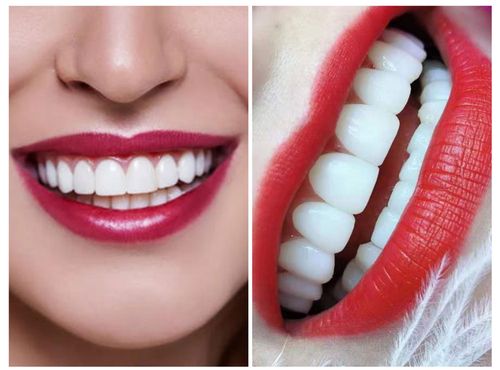 慕梵明星美牙班