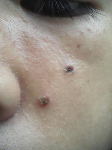 电烧点完痣后第三天,痣的地方有点痒,用纸巾擦的时候有点浅黄色的水