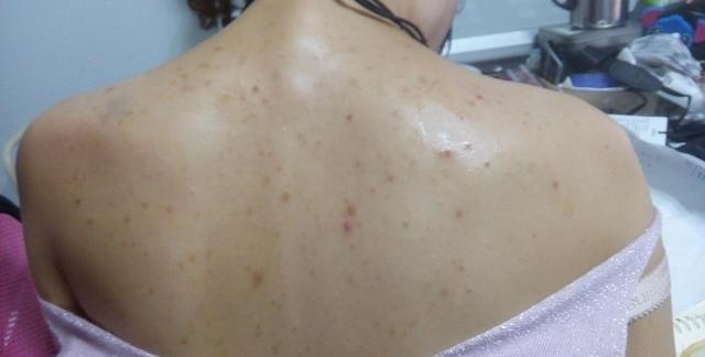 贝赫切特综合征在东亚中东和地中海地区发病率高男性高于女性