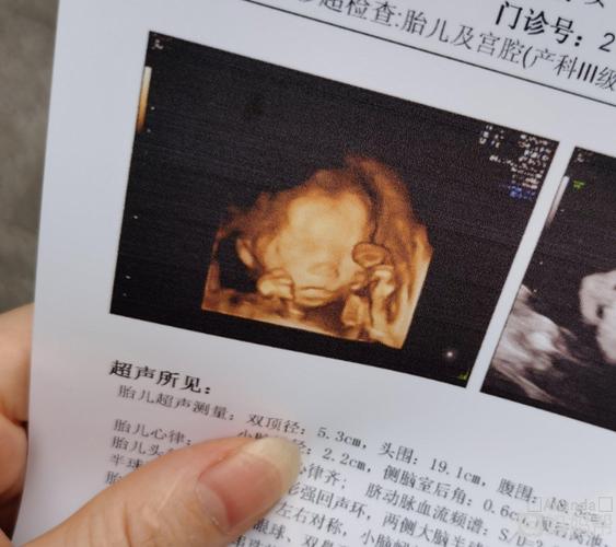 四维彩超,顺利通过!接好孕产检一路绿灯!