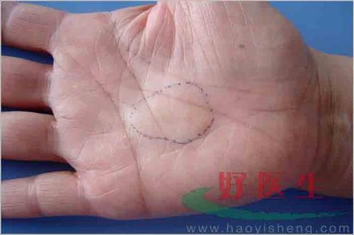 分界清楚,有良好的活动度,与周围组织界线清楚手指活动及感觉无异常