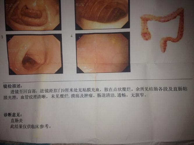 展开全部 肛门坠胀是发生于直肠,肛门,会阴的一种不适症状.